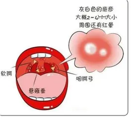 春夏交际幼儿预防传染病知识2