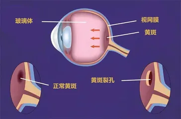 干细胞修好视网膜2