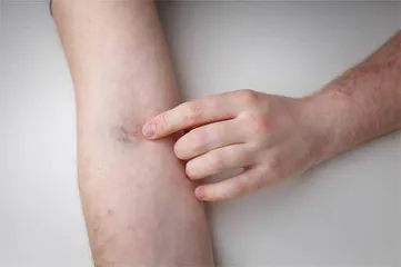 抽血后手臂淤青莫紧张