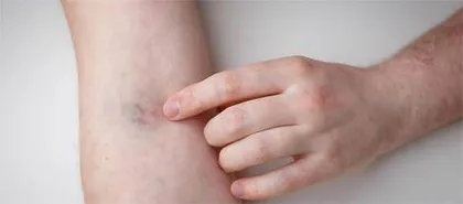 抽血后手臂淤青莫紧张