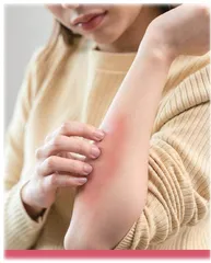 皮疹伴水肿，小心自身免疫病