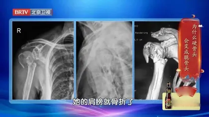 把钙补进骨头里1