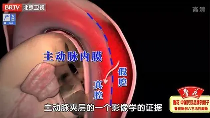 凶险的主动脉夹层5