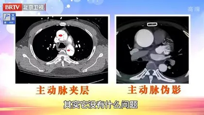 凶险的主动脉夹层8