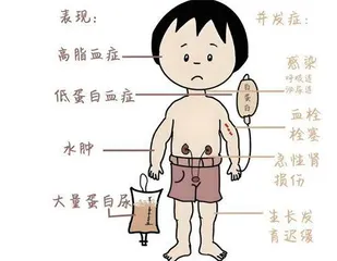 儿童肾病综合征的家庭护理