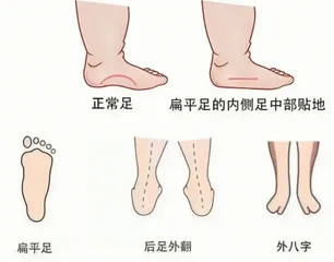 一起了解青少年扁平足1