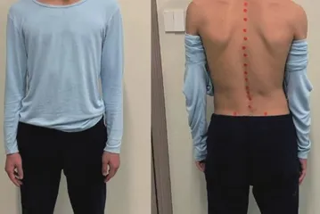 青少年脊柱侧弯的识别与康复策略