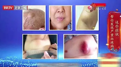 哪种贫血要更加关注3
