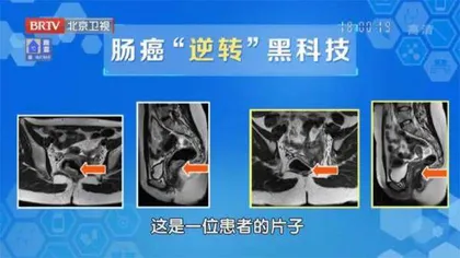 “逆转”肠癌的黑科技6
