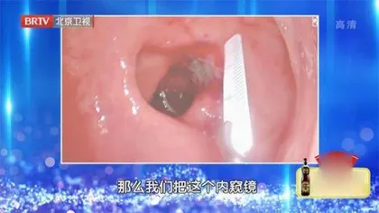 “逆转”肠癌的黑科技7