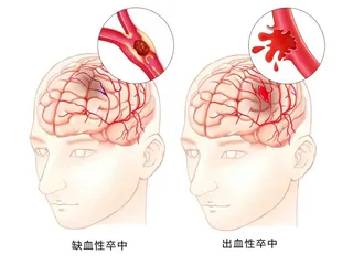 青少年脑出血的救治与康复支持