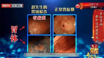 缘何除菌后还会患上胃癌3