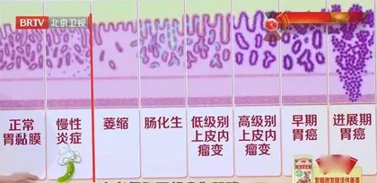 缘何除菌后还会患上胃癌6