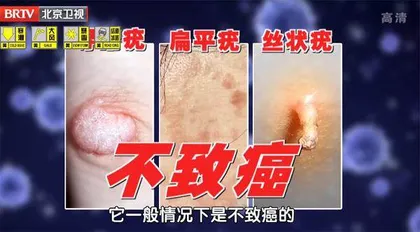 观形辨色识肿瘤4