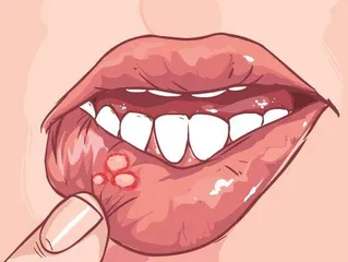 当心致命的口腔溃疡2