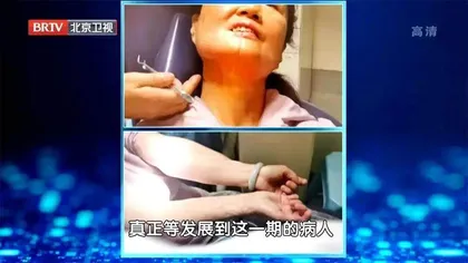 当心致命的口腔溃疡3
