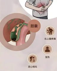 青少年胆囊疾病如何防治