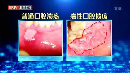 当心致命的口腔溃疡5