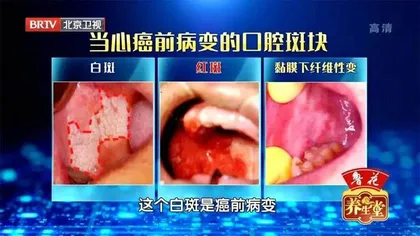 当心致命的口腔溃疡6