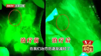 当心致命的口腔溃疡7
