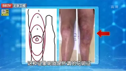 糖友谨防三道坎3