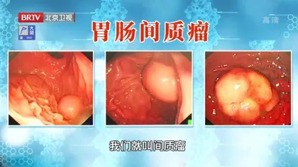 “变化多端”的胃肠肿瘤4