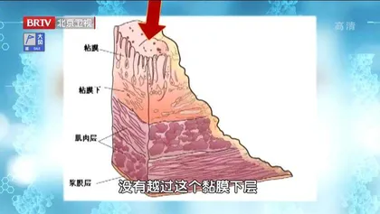 “变化多端”的胃肠肿瘤6