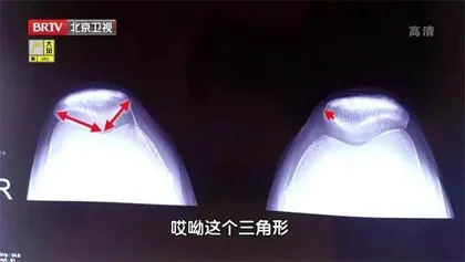 寻找最“长寿”的膝盖3