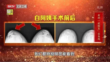 寻找最“长寿”的膝盖4