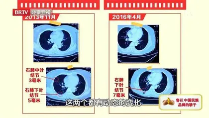 别错过结节的“恶变瞬间”2