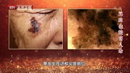 不痛不痒的“坏斑”也是疾病信号1