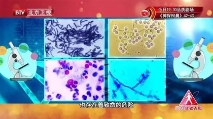 “糖友”需警惕的致命真菌4