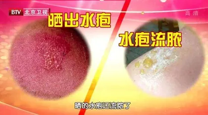 不痛不痒的“坏斑”也是疾病信号3