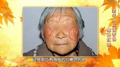 不痛不痒的“坏斑”也是疾病信号4