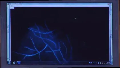 “糖友”需警惕的致命真菌7