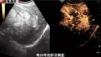 看得见的痰湿,能预防的肿瘤3