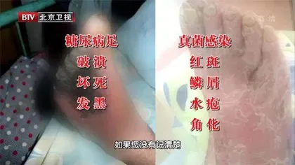 “糖友”需警惕的致命真菌8