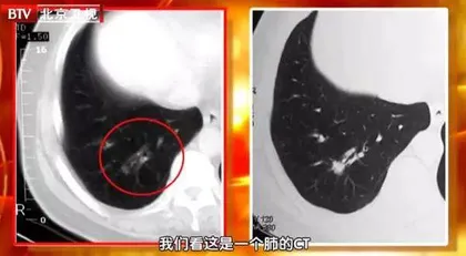 看得见的痰湿,能预防的肿瘤5