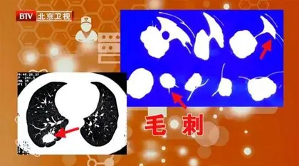 看得见的痰湿,能预防的肿瘤6