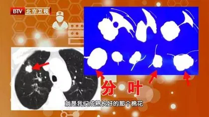 看得见的痰湿,能预防的肿瘤7