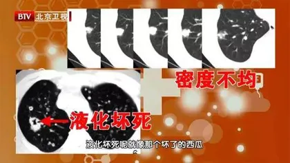 看得见的痰湿,能预防的肿瘤8