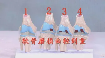 可逆的老年膝4