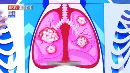 巧辨结节畅呼吸8