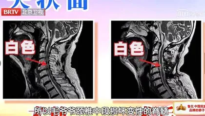 警惕最严重的颈椎病2