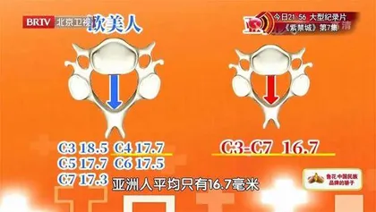 警惕最严重的颈椎病3