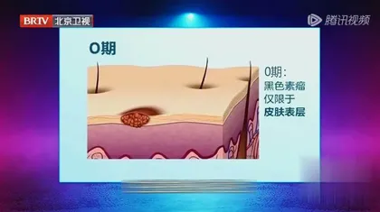 小心身上长“福痣”4