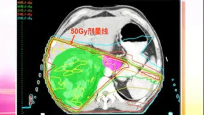 精准打击“哑巴癌”2