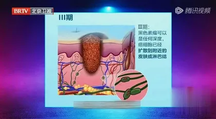 小心身上长“福痣”6