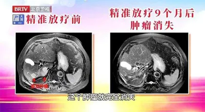 精准打击“哑巴癌”3