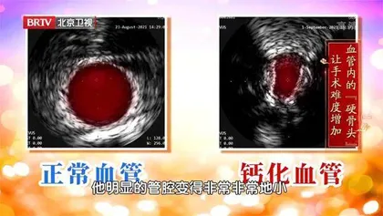 警惕血管钙化, 别让自己变得“铁石心肠”2